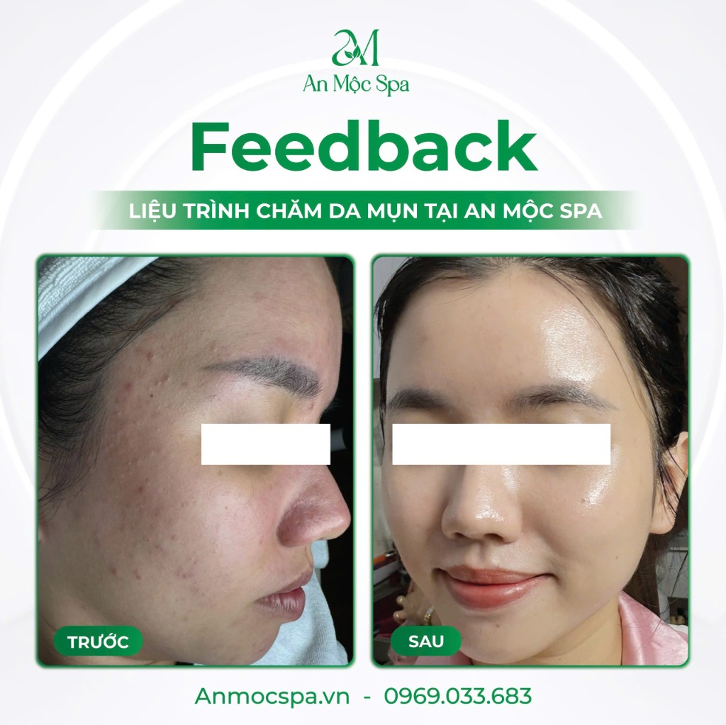 Kết quả trị mụn tại An Mộc Spa - Trước và Sau